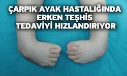 Çarpık ayak hastalığında erken teşhis tedaviyi hızlandırıyor